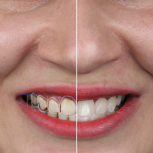 Smile Design طراحی لبخند دیجیتال